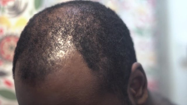 african american black male has signs of receding hairline and male pattern baldness reflection from the mirror in the bathroom