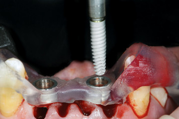 highly precise implantation using the surgical template