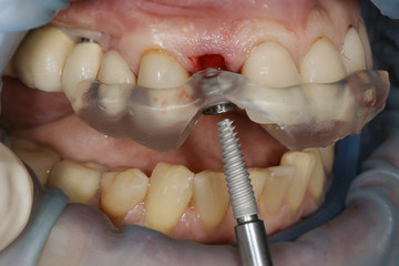 Photo-quality implant incisor on the surgical template