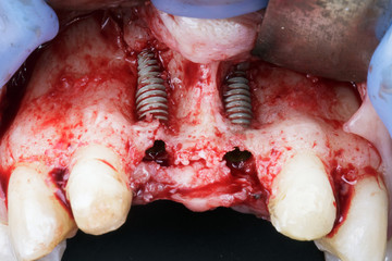 two installed implants and soft tissue detachment during difficult implantation