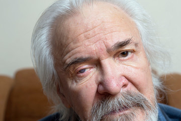 Eye disease in an old man
