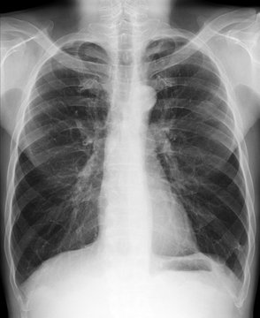 X-ray picture - Chest