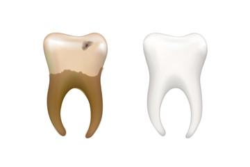 Healthy bright human tooth and old dirty tooth with caries isolated on white, dental health concept illustration