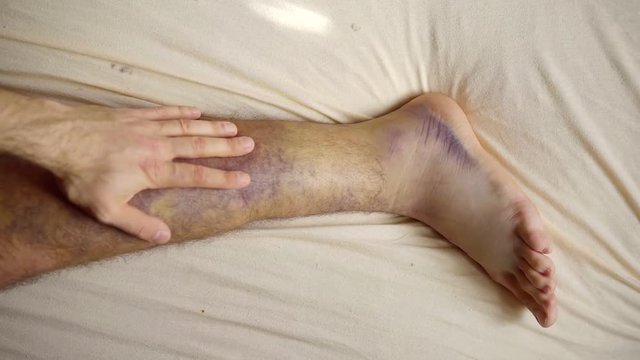 male patient is stroking his broken leg with hematomas in hospital room