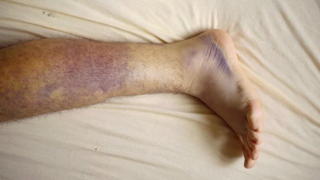 man is trying to move fingers of his broken leg and foot on hospital bad, close-up