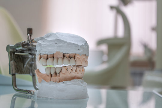 Gypsum Stomatologic human jaws. Ceramic-metal crown on plaster model on blurred background of dental office.
