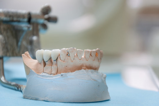 Gypsum Stomatologic human jaws. Ceramic-metal crown on plaster model on blurred background of dental office. White tone