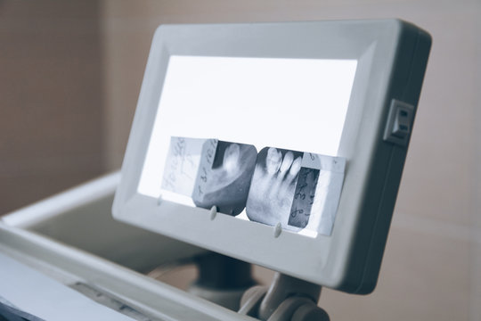 X-ray picture on led background. Dental care, dental hygiene, checkup and therapy concept. White tone