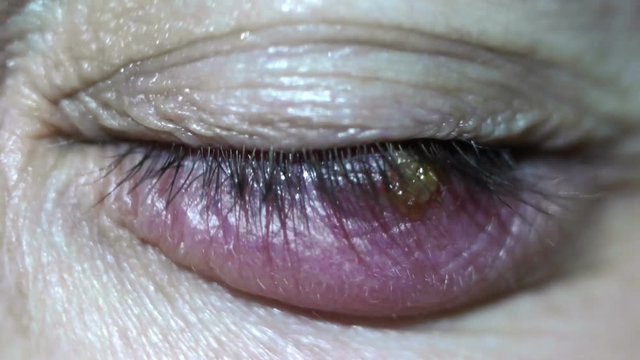 Stye eye Infection