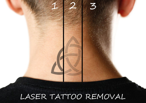 Laser tattoo removal. Close up. Isolated on white background