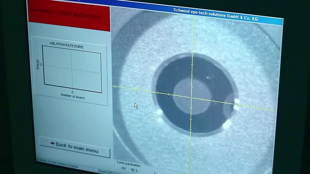 cataract surgery on monitor, Surgeon operating eye cataract in hospital surgery, ophthalmology operation, surgery eye, monitor of medical laser, eye on medical monitor