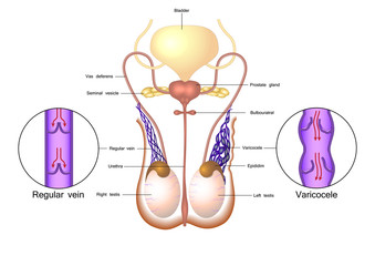 Varicocele in male reproductive system