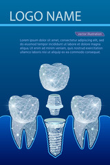 Healthy teeth and dental implant. Dentistry. Implantation of human teeth. Vector illustration
