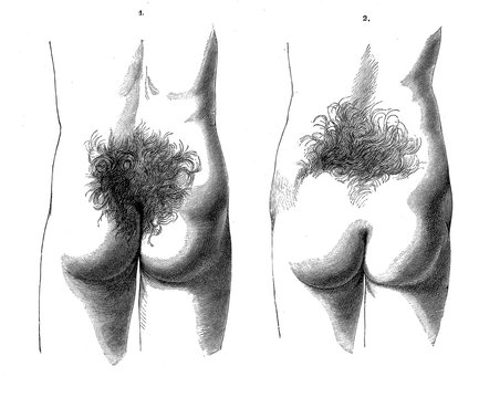 Vintage illustration of anatomy, human  male and female trichosis, hairiness in sacral region