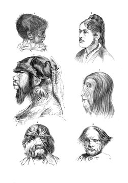 Vintage illustration of anatomy, human  male and female heads with trichosis, hairiness disease