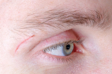 Fototapeta premium A scar near the eye with an eyebrow on a man of European appearance. Close up.