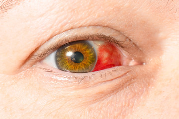 Subconjunctival hemorrhage - hyposphagma. Closeup of woman's face showing red bloodshot eye with...