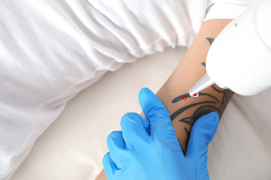Woman undergoing laser tattoo removal procedure in salon, closeup