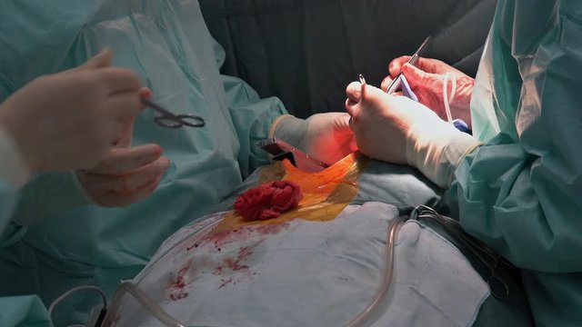 Surgeons team operating heart operating live shot