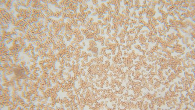 Blood, diseases, interstitial fluid, bacterial background, research using a microscope at extreme magnification of about..