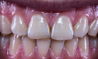 Healthy human teeth with normal occlusion from frontal view .