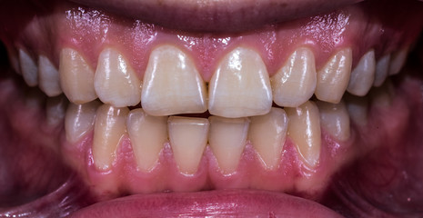 Healthy human teeth with normal occlusion from frontal view .
