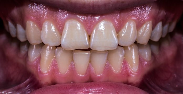 Healthy human teeth with normal occlusion from frontal view .