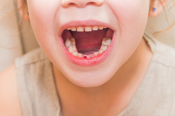 a girl, a child lost a tooth, hole, oral hygiene