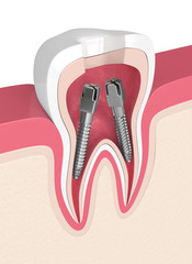 Obraz premium 3d render of tooth with dental root canal posts