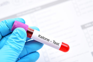 Blood sample tube for ketone test, diagnosis for diabetic ketoacidosis
