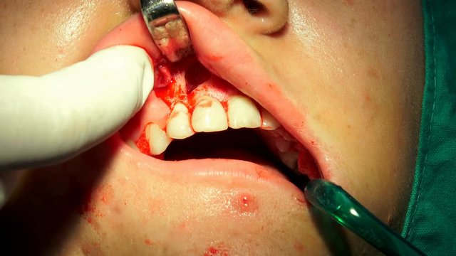 Girl at Tooth, Gum, Oral surgery, apicectomia in dark operation room