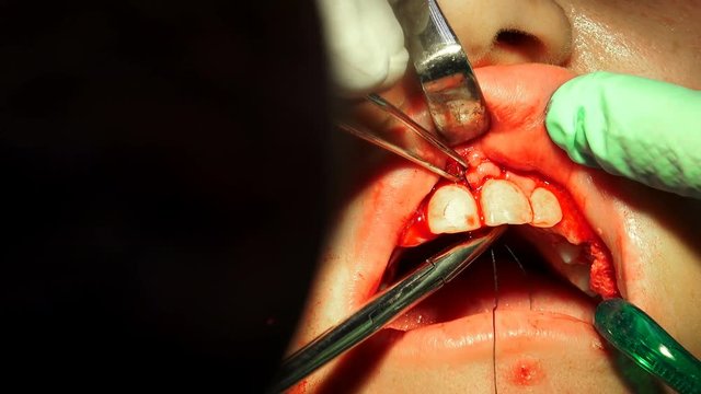 Metal stitch needle closes wound from curgical operation of tooth cyst removal