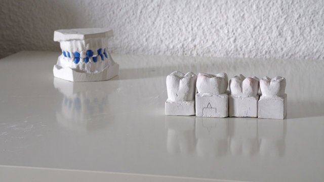 Dentist line up models of teets for prosthetic denture jaw