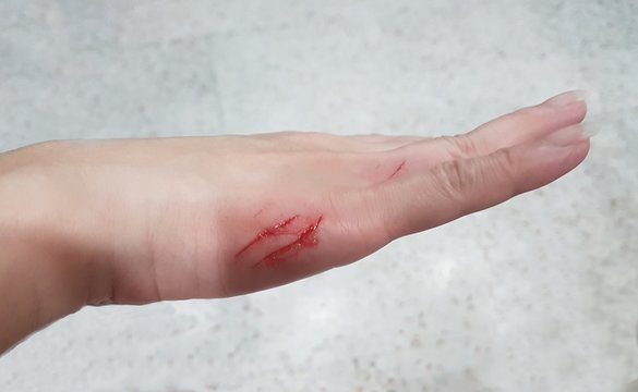 Foreground close-up image of a girl's hand badly cut and bleeding on the side of her palm 