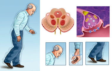 Parkinson's disease Schematic and descriptive composition.