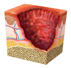 Descriptive illustration of a segment of ulcerated skin.