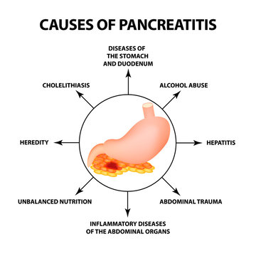 Causes of pancreatitis. The structure of the stomach and pancreas. Infographics. Vector illustration on isolated background
