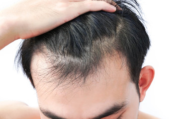 Fototapeta premium Young man serious hair loss problem for health care medical and shampoo product concept