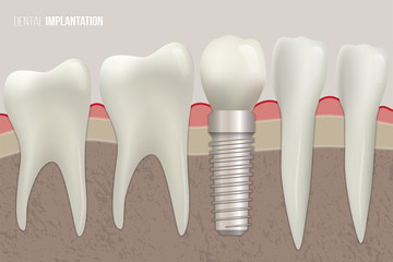 Dental implantation vector illustration. Sound teeth and dental implant on medical illustration.