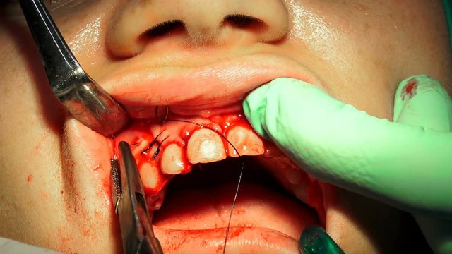 Dentist stitches women gum after tooth surgical operation of cyst removal