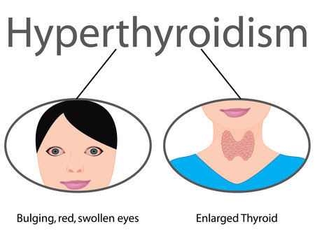 Hyperthyroidism.  Enlarged Thyroid. Endocrine disfunction vector illustration