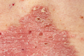 Fototapeta premium Psoriasis Vulgaris - detail of psoriatic skin disease, an autoimmune skin disorder is typically red, itchy, and scaly, macro with narrow focus