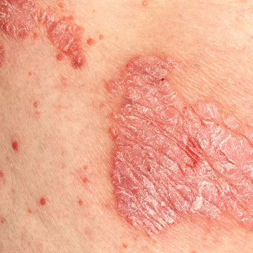 Psoriasis Vulgaris - detail of psoriatic skin disease, an autoimmune skin disorder is typically red, itchy, and scaly, macro with narrow focus