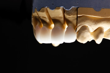 Fototapeta premium White front teeth veneers on diagnostic model on dark background. Close up.