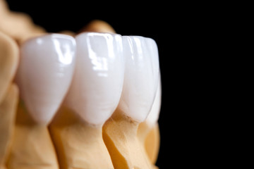 Fototapeta na wymiar White front teeth veneers on diagnostic model on dark background. Close up.