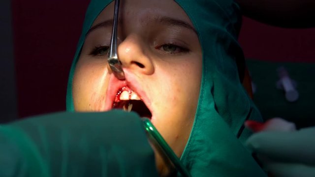 Oral dental surgery operation cut stitch, tooth gum apicactomy cyst removal