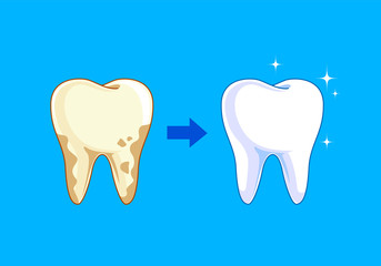 Tooth before and after. Yellow becomes white, Dental care concept,  illustration isolated on blue background.