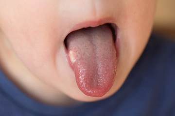 Close-up of child with aphtha or stomatits on mouth