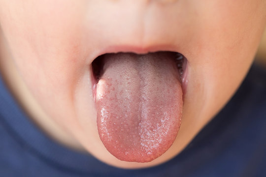 Close-up Of Little Kid Boy With Aphtha Or Stomatitis Or Canker On Tongue In His Mouth