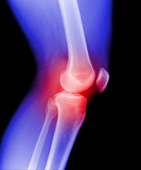 x-ray of joint